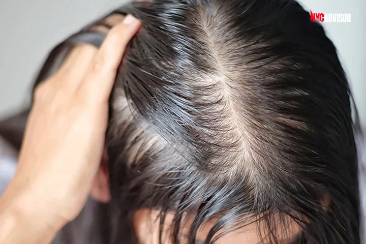 Hormonal Treatment for Hair Loss